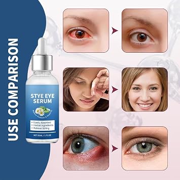 Eye Stye Serum, Under Eye Serum, Eye Care Products For Styes Chalazion And Blepharitis,Soothes, Swelling, and Redness, Gentle Formula,Daily Cleanser For Dry Eye Comfort