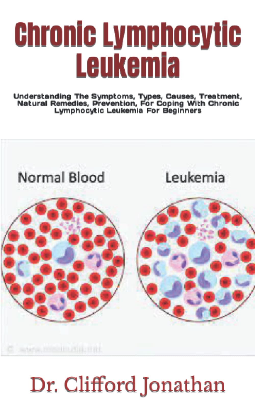 Buy Chronic Lymphocytic Leukemia Understanding The Symptoms, Types