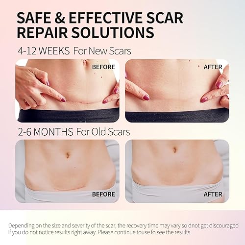 Miniatura 6 de Hojas de silicona médica para cicatrices, cinta de cicatriz de silicona, cinta de cicatriz reutilizable para cirugía de cesárea, queloides y