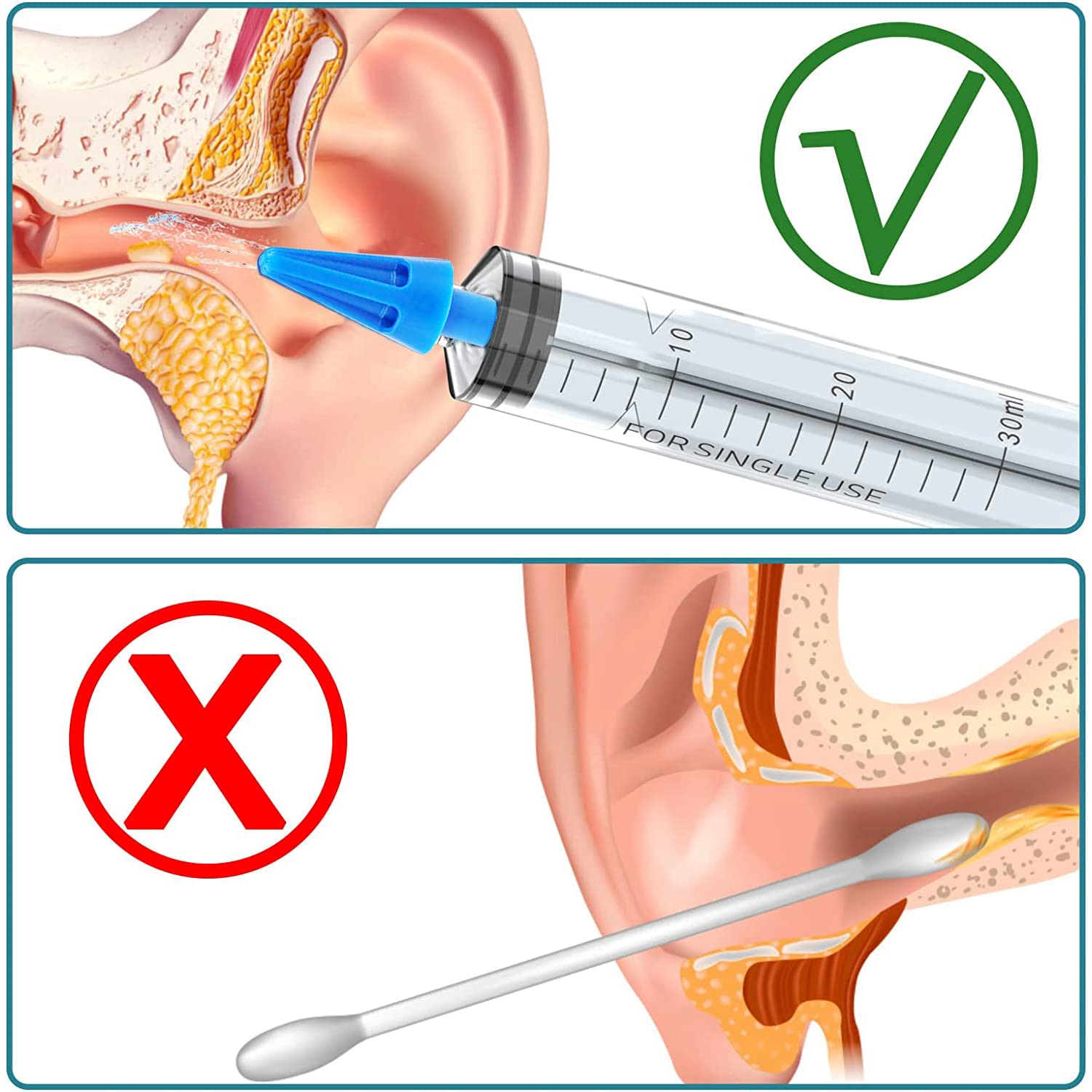 Pulitore Orecchie con 4 Punte a Getto Quintupla, Kit Siringa Pulisci Orecchie, Pulitore Intelligente per le Orecchie per Rimuovere il Cerume Facile da pulire per Bambini e Adulti