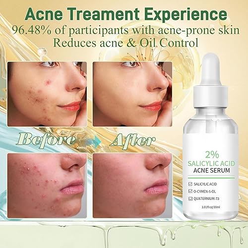 Miniatura 4 de Suero de tratamiento del acné con ácido salicílico al 2% y niacinamida-centella asiática aceites de reparación facial para piel sensible y propensa