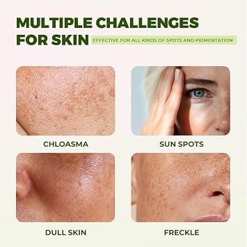 2Pcs Dark Spot Remover for Face & Body, Dark Spot Corrector Aloe Balm, Hyperpigmentation Melasma Cream for Age Spot Sun Spot Freckles, Hydrating & Evens Skin Tone, for All Skin Types