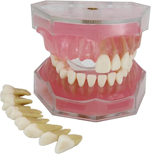 Modelo de dientes de implante dental con dientes extraíbles para profesionales dentales y estudiantes