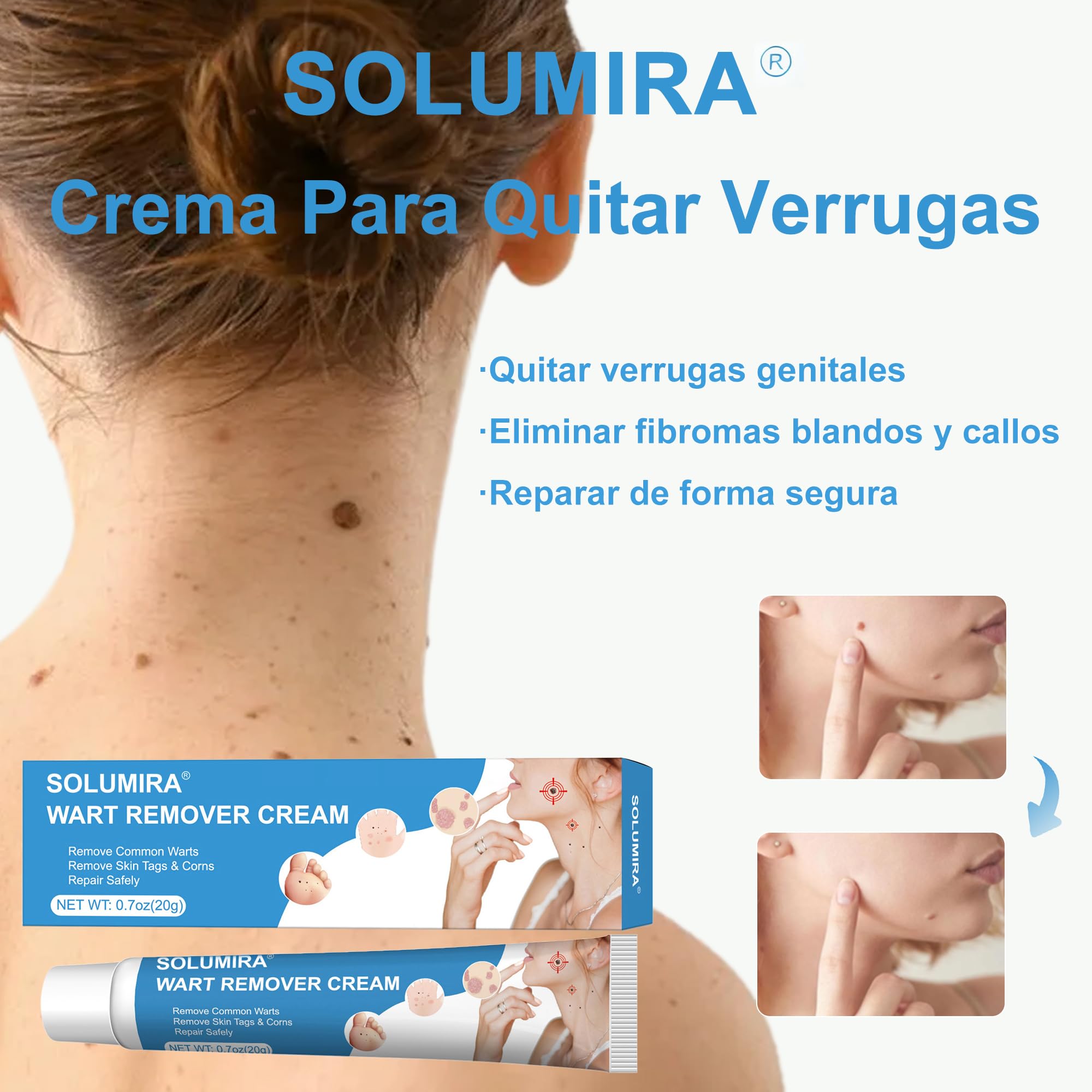 Crema para verrugas y acrocordones 20g – Elimina verrugas comunes, plantares, callos y acrocordones en rostro y cuerpo
