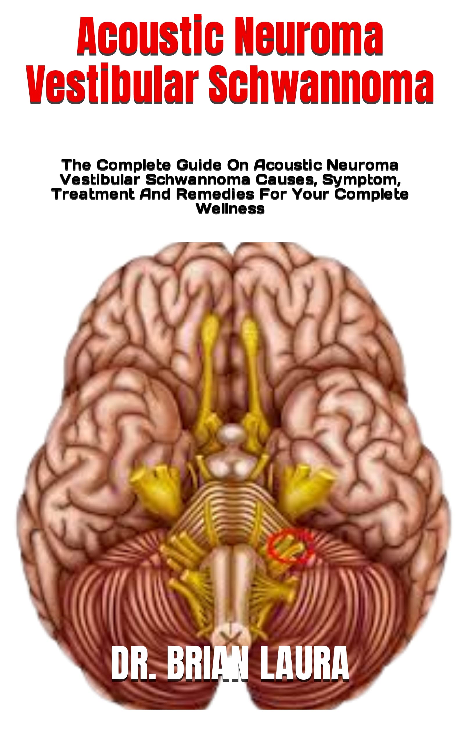Buy Acoustic Neuroma Vestibular Schwannoma The Complete Guide On
