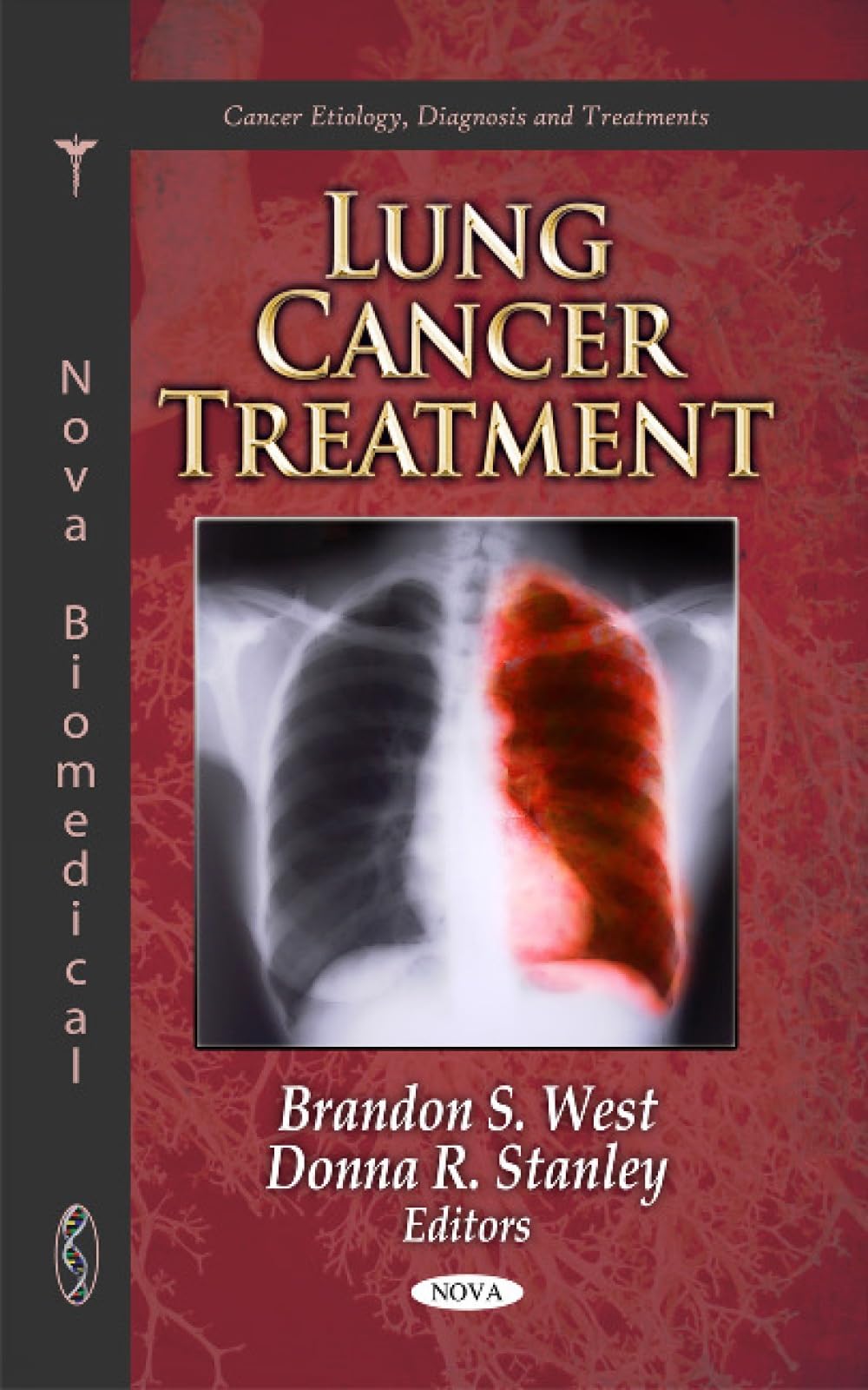 Buy Lung Cancer Treatment (Cancer Etiology, Diagnosis and Treatments) — BookShops.in
