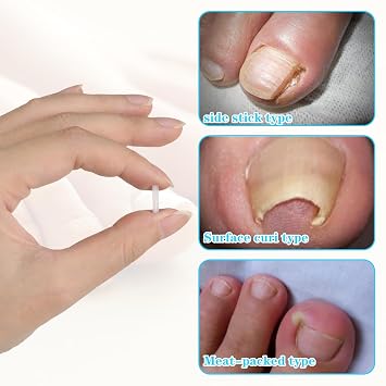 (50+1) Pcs Ingrown Toenail Corrector Treatment Set, Professional Pain-Free Ingrown Toenail Removal Kit with Toenail Lifter, Easy Fixed Ingrown Toenail Tool, Toenail Straightener Strip for Men Women