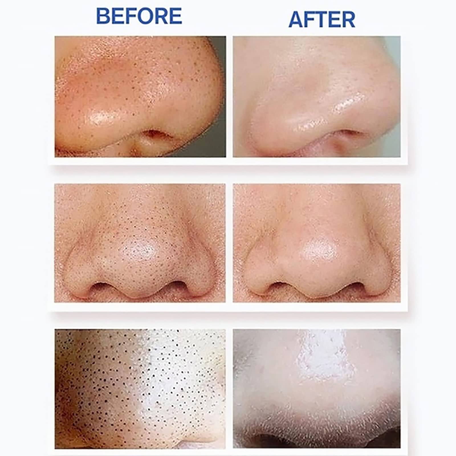 Limpiador facial de poros – Aspirador de poros para eliminar puntos negros, herramienta extractora de puntos blancos de comedones de acné, herramienta de succión de puntos negros, extractor de
