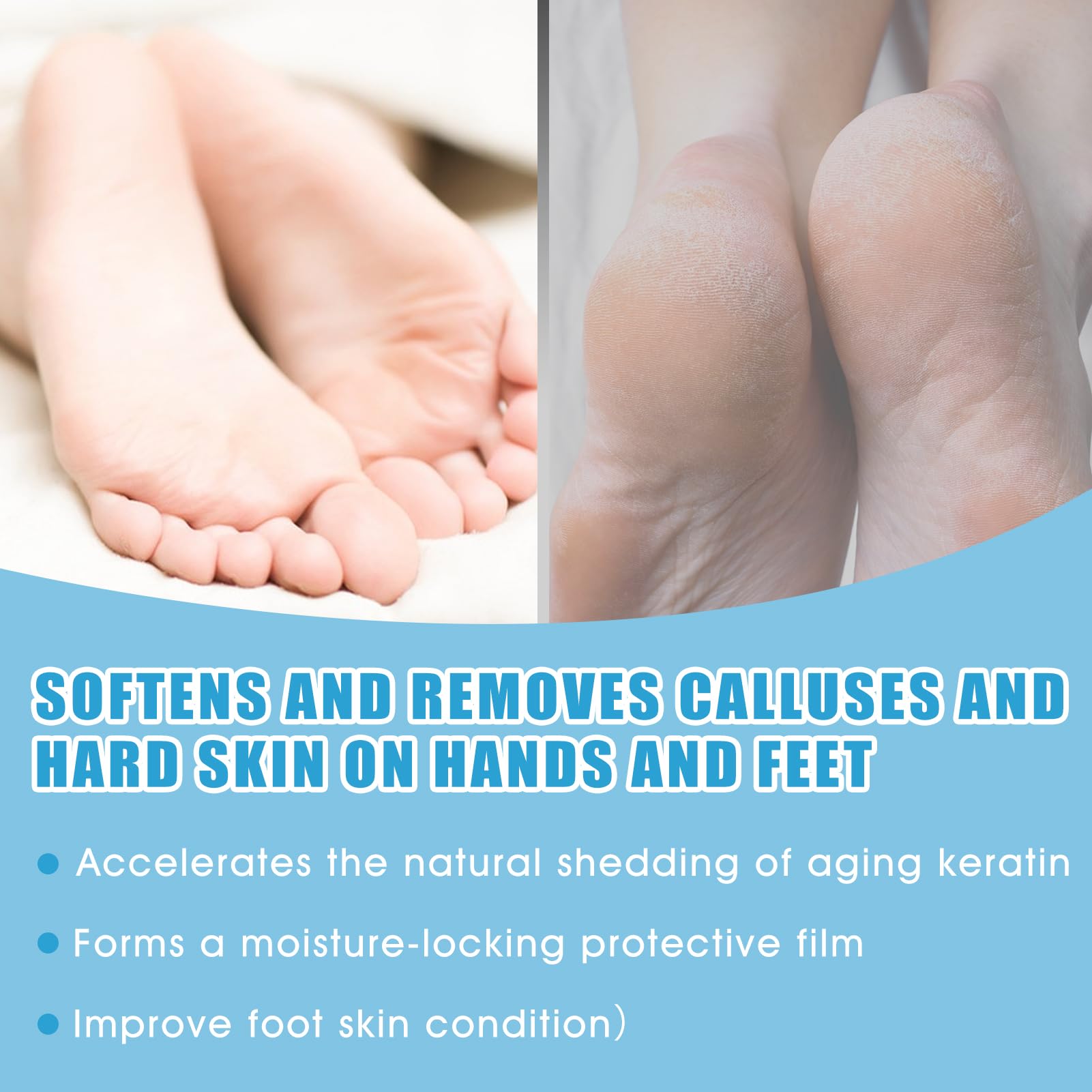Cheratolitico Piedi, Callus Remover, Esfoliante Piedi, Lima per Piedi in Nano-Vetro, Ammorbidisce la Pelle dei Piedi, Idrata in Profondità, Allevia Secchezza e Screpolature, 250 ml