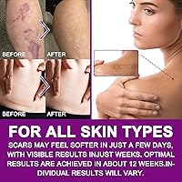 Vista 5 de Hojas de silicona para cicatrices (1.6 x 60 pulgadas, 1.5 M), cinta transparente para cicatrices, tiras de cicatrices de silicona, cicatrices