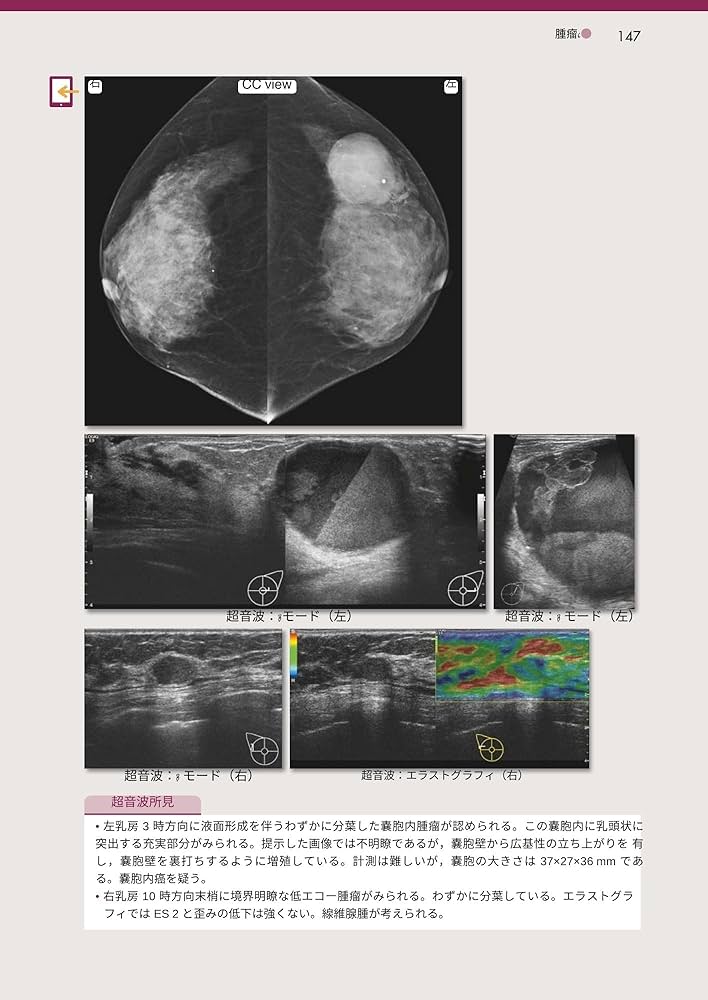 マンモグラフィ診断の進め方とポイント 第5版補訂版: [Webでみる拡大