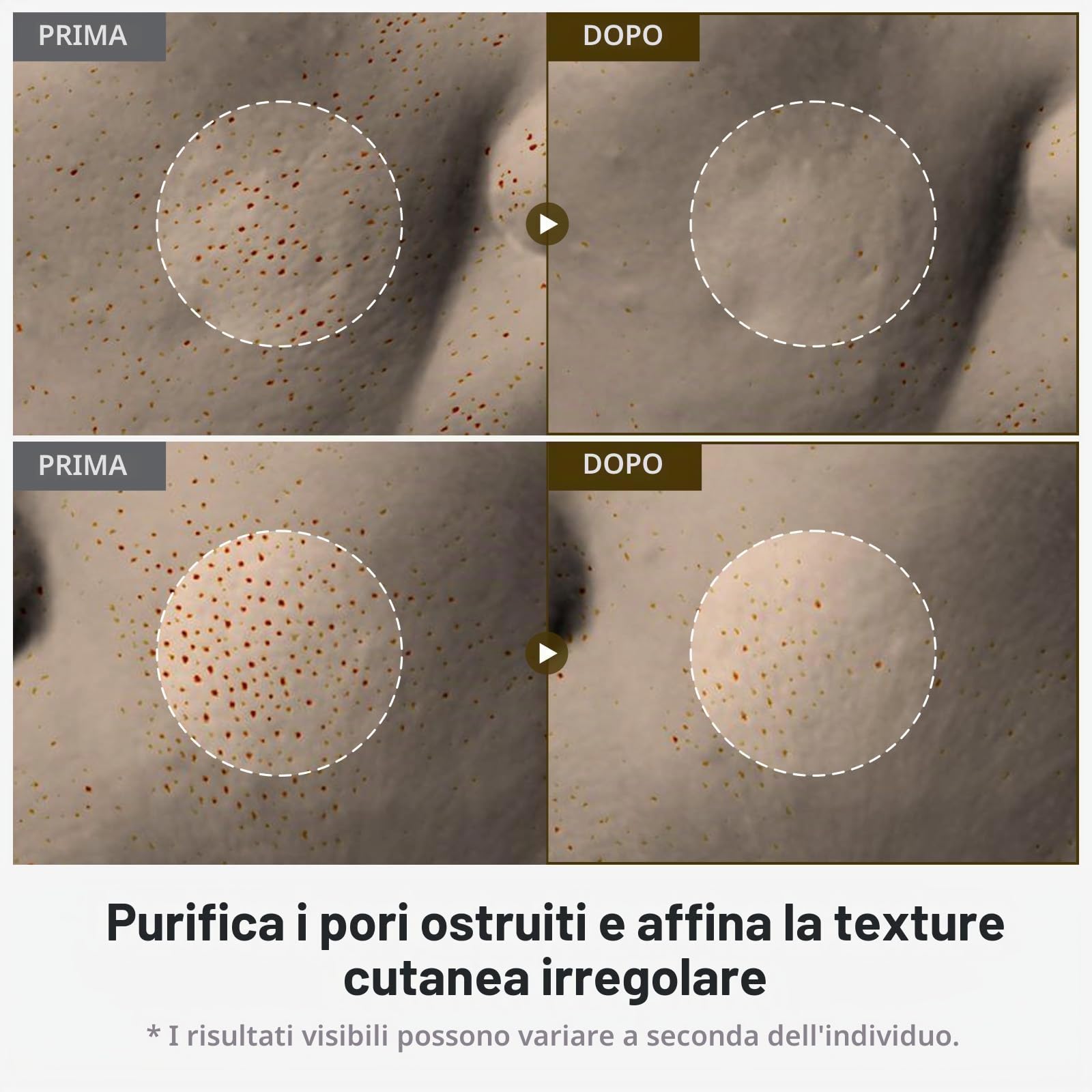 TOSOWOONG Fiala Peeling Riso Bianco 75% per Pelle Spenta e Discromie | Acido Kojico, Niacinamide, Esfoliante, cellule morte, Punti Neri, pori puliti, Viso e Corpo, K-Beauty, 85 ml