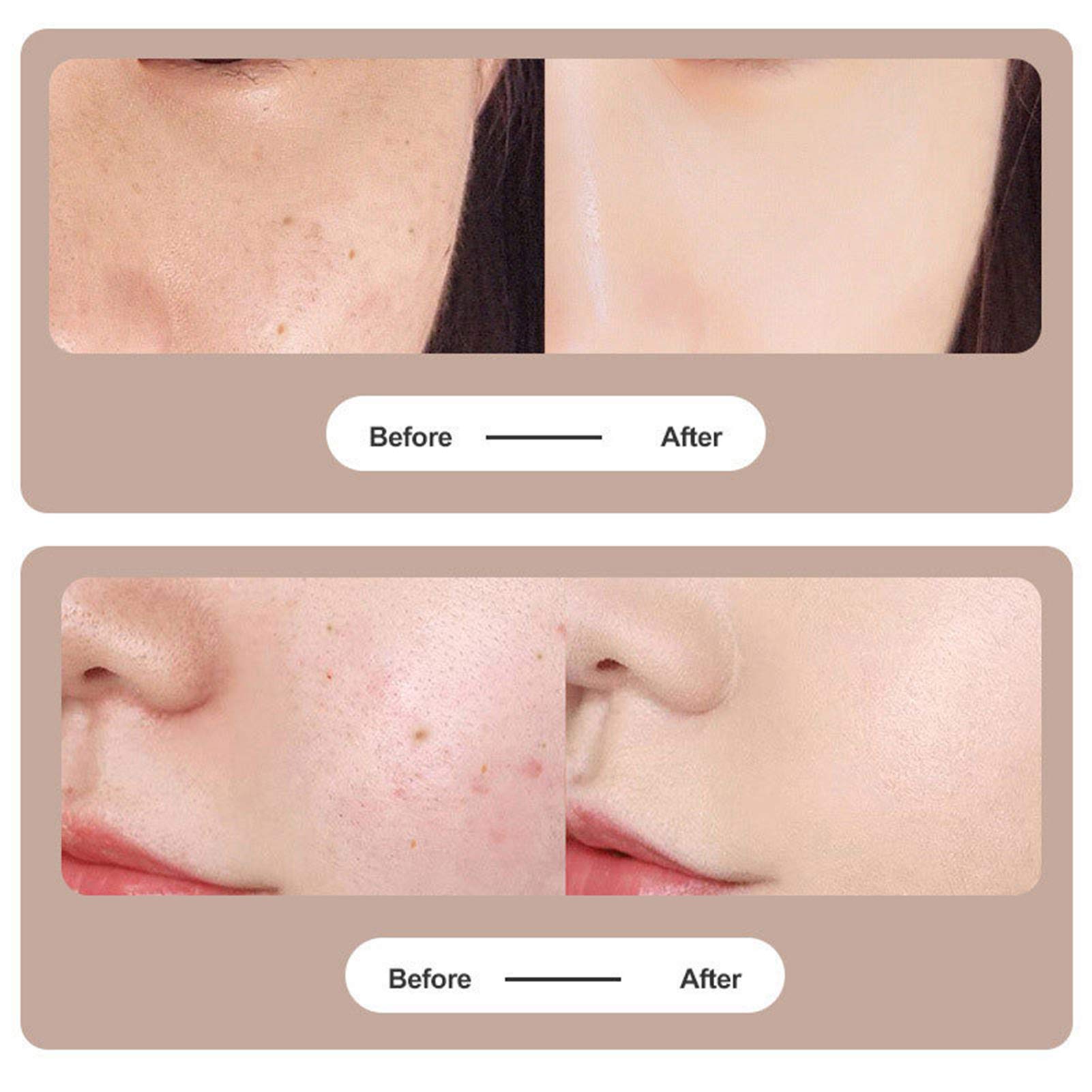 Stylo Laser Plasma Pour Enlever Taches, Grains De Beauté, Tatouages - Neuf