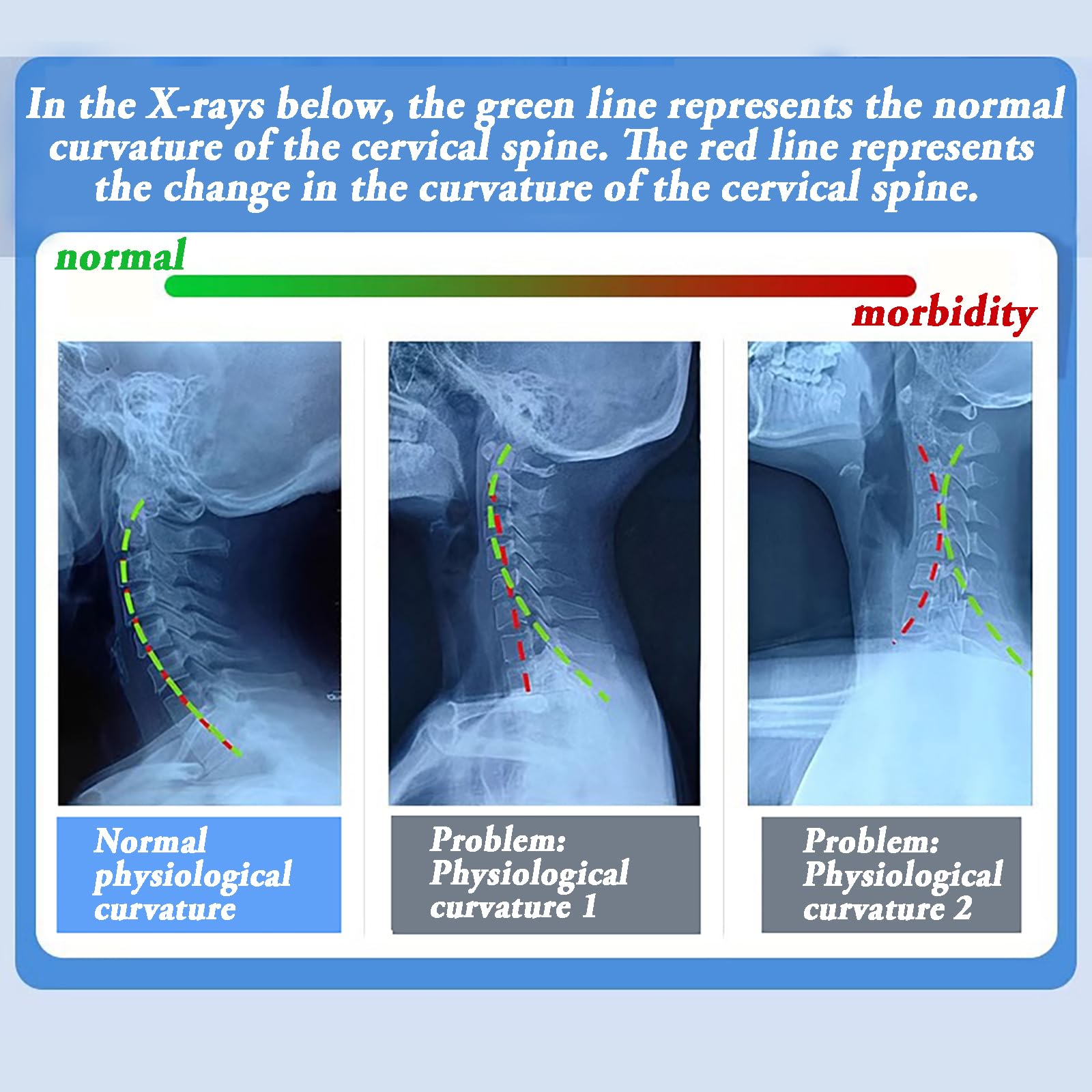 Dispositivo De Tracción Cervical,Inflado Manual,Inflado Manual,Regulable En Altura,Adecuado Para El Dolor De Cuello,Estiramiento Espinal