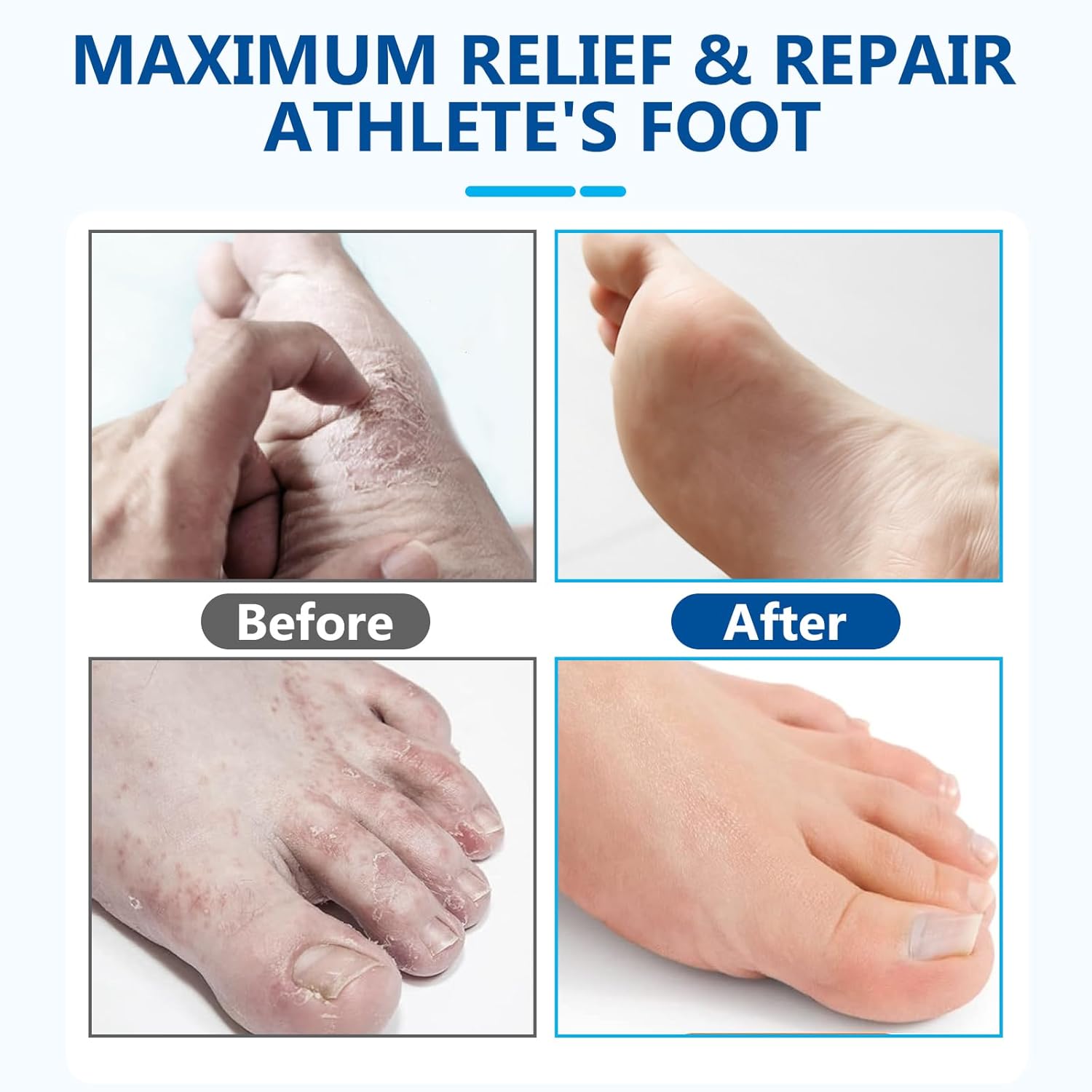Athletes Foot Spray-Athletes Foot Treatment for Itchy, Sweaty & Uncomfortable Skin, Gently Soothes Feet, Toes & Groin Area | Deodorizing, 1.01 Fl.Oz - Image 7