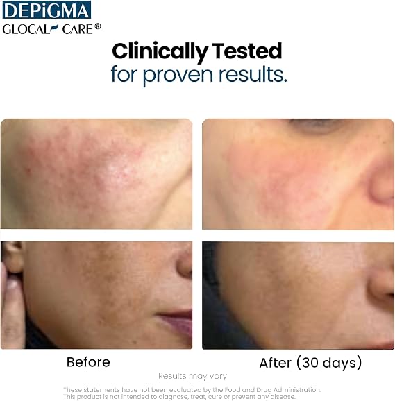 GlocalCare Depigma Capsules Support Reduction of Hyperpigmentation, Melasma & Dark Spots with Glutathione, Polypodium Leucotomos, Grape Seed & Marigold Extract