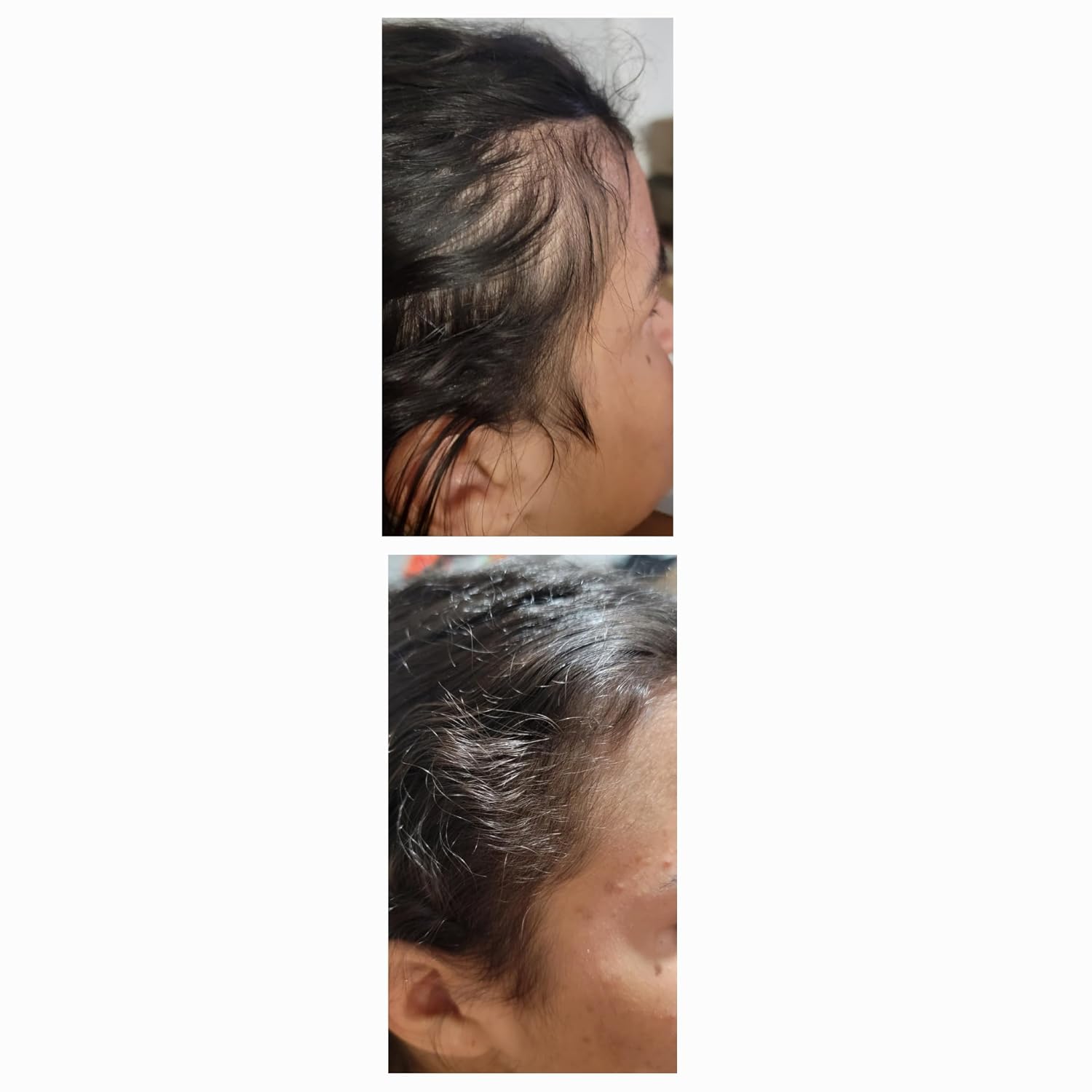 DHT BLOCKER Hair Growth Serum with 25+ Botanical Extracts, PROVEN hair loss Treatment, VISIBLE RESULTS in 90 Days, Non-Greasy Formula, Fuller & Thicker Hair, For Men & Women