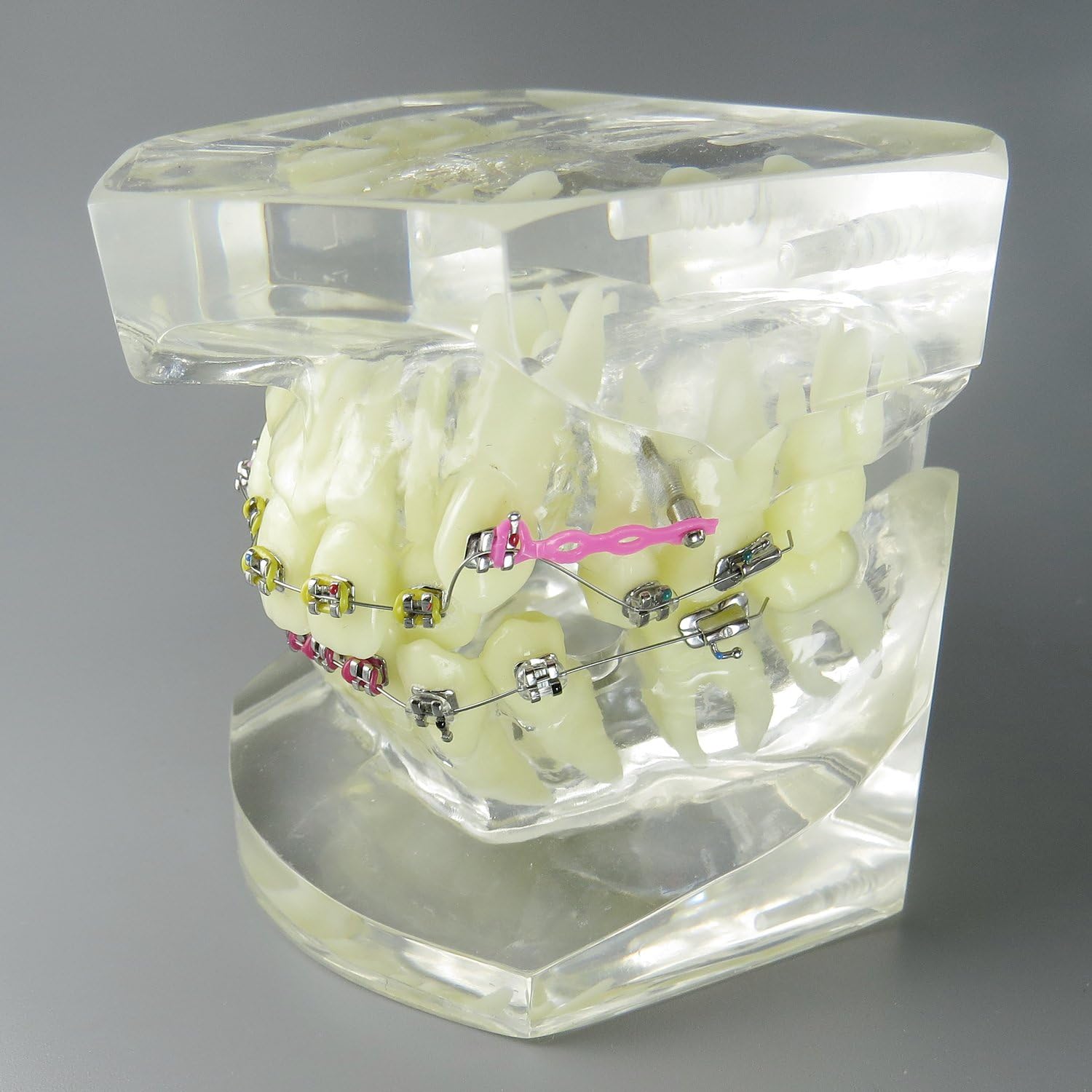 Dental Malocclusion Orthodontic Treatment Teeth Model with Metal Brackets Wires Colorful Ties Chains and Hoops M3005
