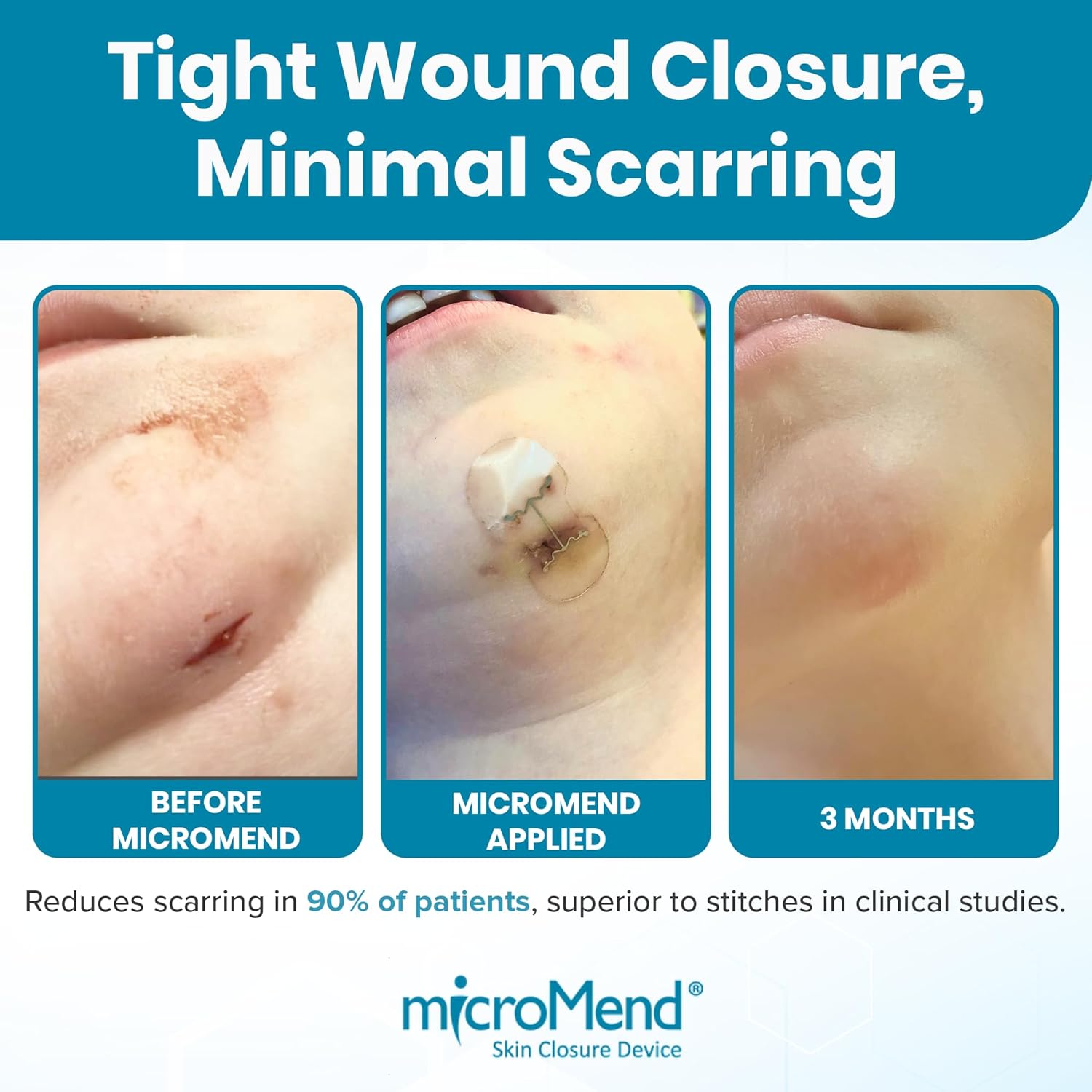 Emergency Wound Closures - Surgical-Grade Laceration Repair Without Stitches | Skin Closure Alternative to Butterfly Bandages | First Aid Kit Essential (6 Medium Wound Closure Devices)