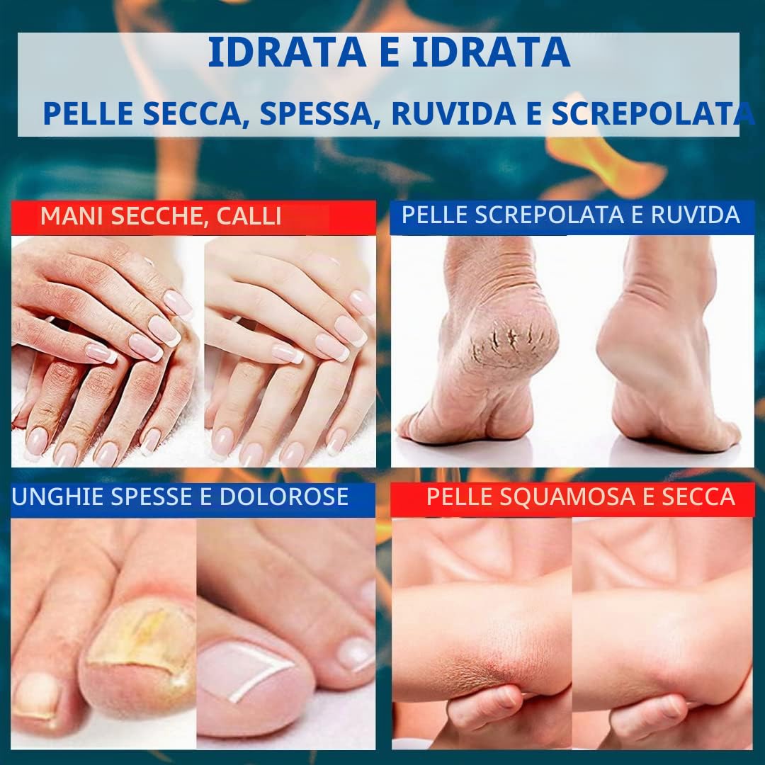 TIS - Crema con urea 30%, per rimozione cicatrici e ferite, eczemi, cheratosi, psoriasi, eruzioni cutanee. Con acido lattico - Alfaidrossiacidi, corteccia di quercia e olio di germe di grano.