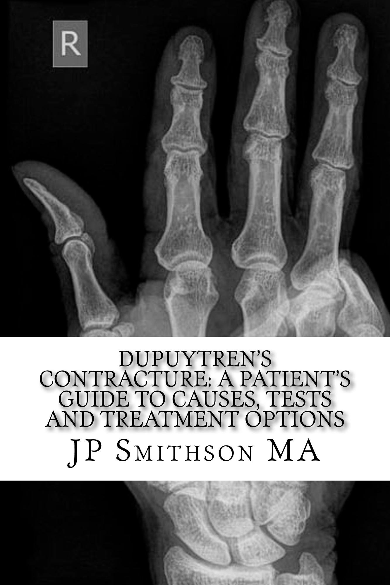 Buy Dupuytren's Contracture A Patient’s Guide to Causes, Tests and