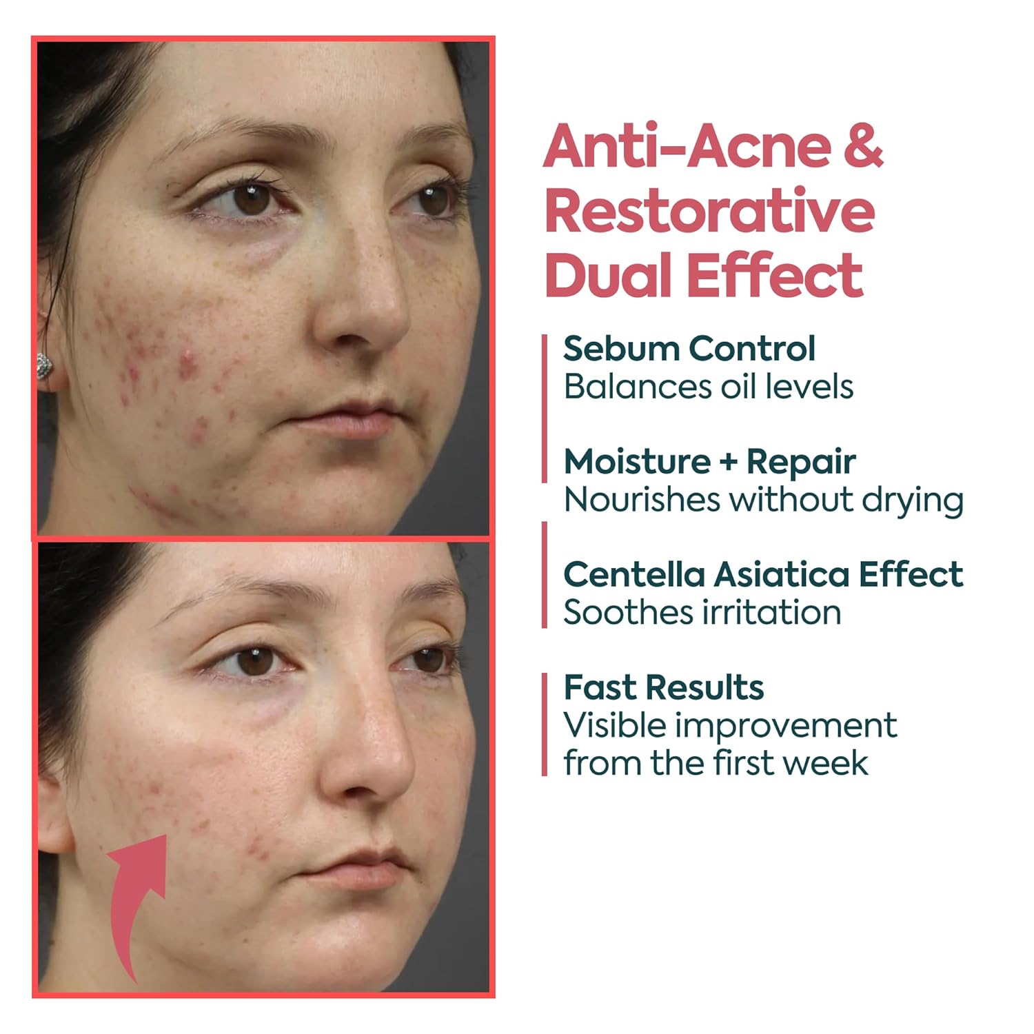 Acne Cream for Face – Spot Treatment for Pimples & Acne Scars – Salicylic Acid & Niacinamide for Scar Removal – Teen & Adult Skincare with Zinc PCA - Image 6