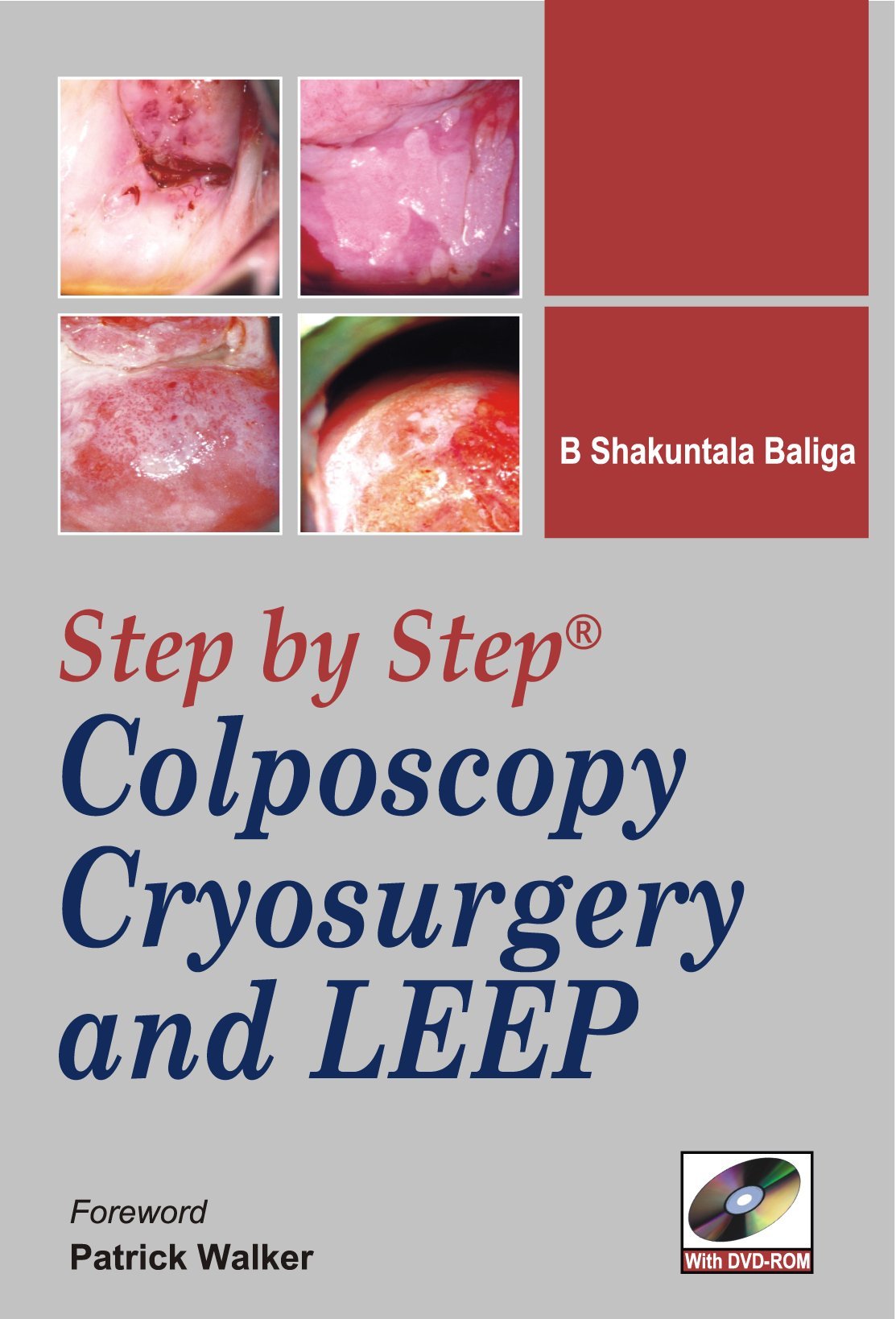 Step-by-Step Colposcopy, Cryosurgery, and LEEP Paperback – 16 Nov. 2009