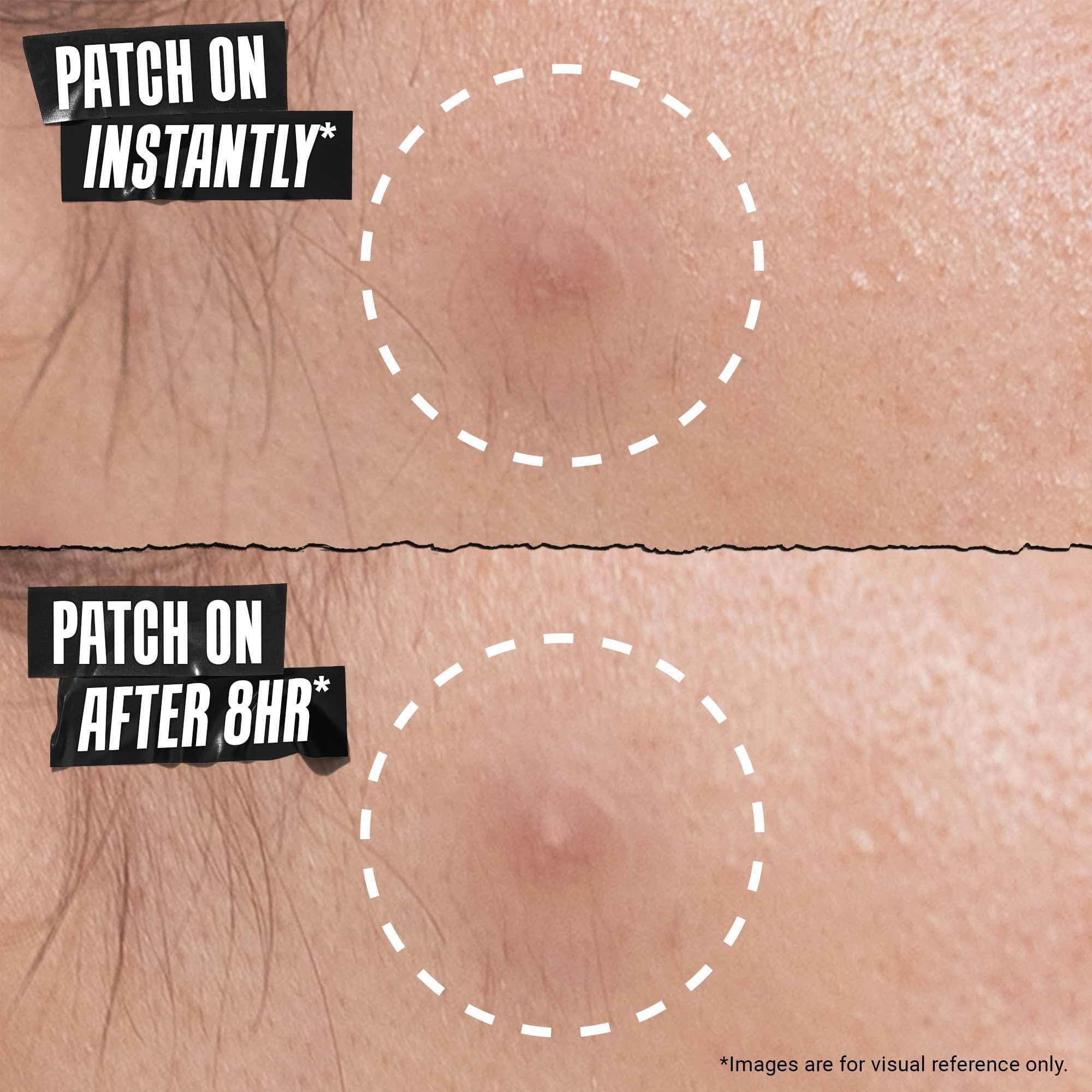 Kiehl's Truly Targeted Overnight Blemish Patch, Hydrocolloid Patch for Blemishes — view 5