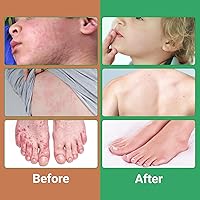 Vista 4 de Crema Urticaria para el alivio de la urticaria, tratamiento antipicazón de acción rápida con fórmula herbaria natural para erupciones alérgicas