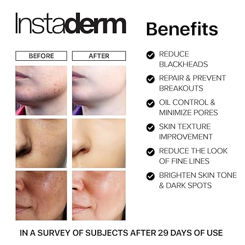 Miniatura 3 de Complexion Renewal Pads-Eliminates Acne, Cystic Breakouts, Pimples, Oily Skin & Clogged Pores. Reduces Appearance of Uneven Skin Tone, Dark Spots,