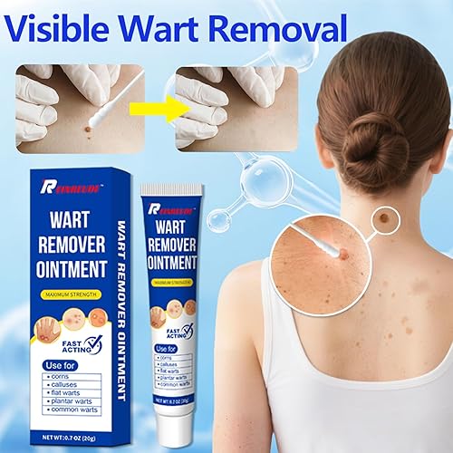 Miniatura 2 de Reinreude Pomada Removedor de Verrugas, Ácido Salicílico 17%, Eliminación Rápida, Removedor de Verrugas de Acción Rápida, para Congelar y Eliminar