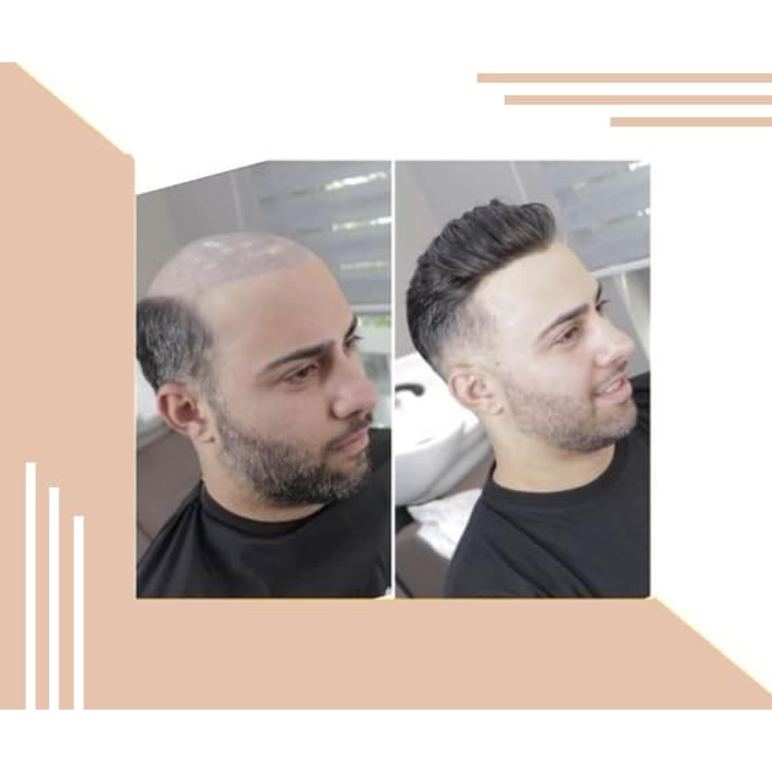 HAIR SECRET MONOFILAMENT Smart Hair Patch for Men, Soft Hair Wig in Black Human Hair, Easy Fit with Tape (8x6) 1