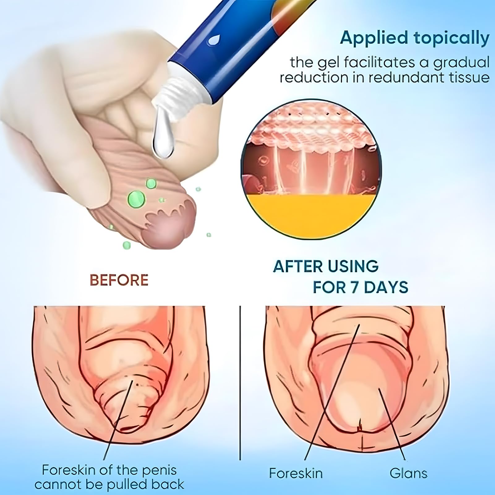 Gel Correcteur Phimosis - Ingrédients Naturels Pour Rétrécissement Du Prépuce - Alternative Non Chirurgicale - Soulagement Rapide