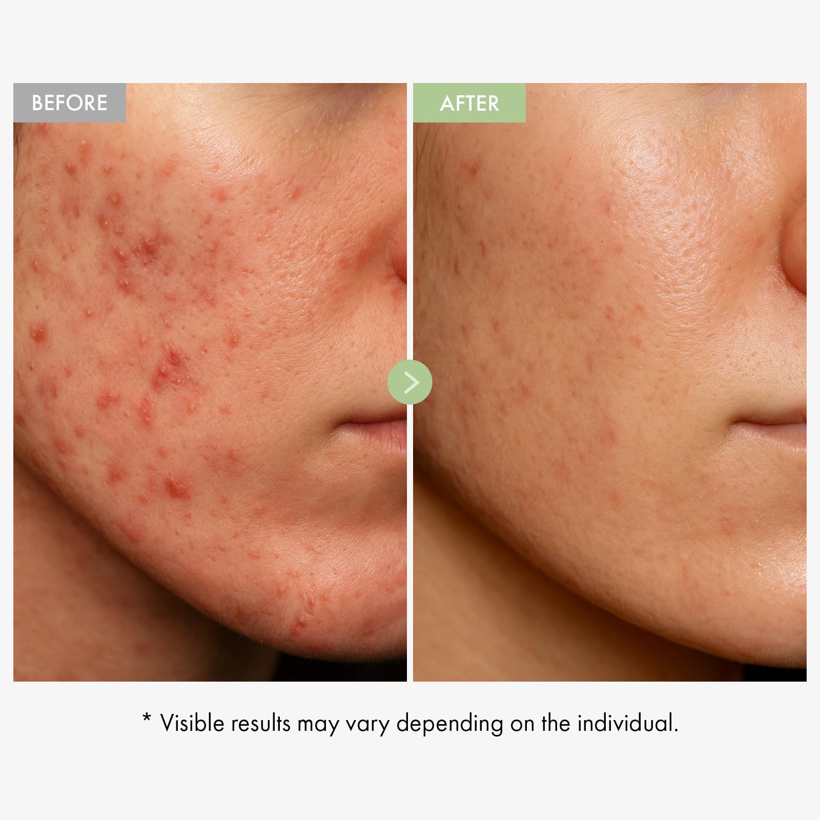 Dúo Calmante K-Beauty: TOSOWOONG Crema Cica y Sérum Ácido Azeláico para Alivio del Enrojecimiento y Claridad de la Piel