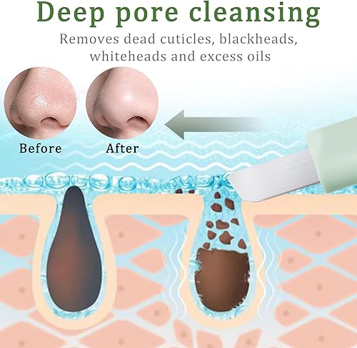 Miniatura 3 de Herramientas de eliminación de puntos negros, raspador de nariz para puntos negros, rascador de poros limpios, herramienta de limpieza profunda