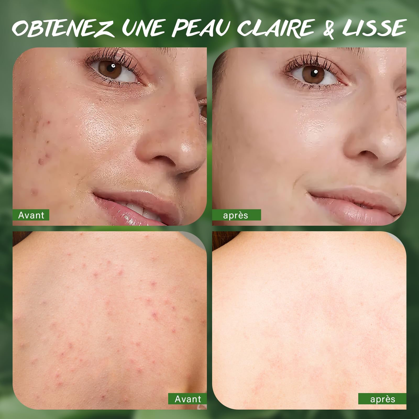 Savon à L'Huile D'Arbre à Thé, Savon de Bain Bio Pour les Mycoses CutanéEs, L'Acné et les Peaux Grasses, ÉLimine la Transpiration, les Odeurs et les DéMangeaisons, Cadeau de FêTe des MèRes, 2x150g