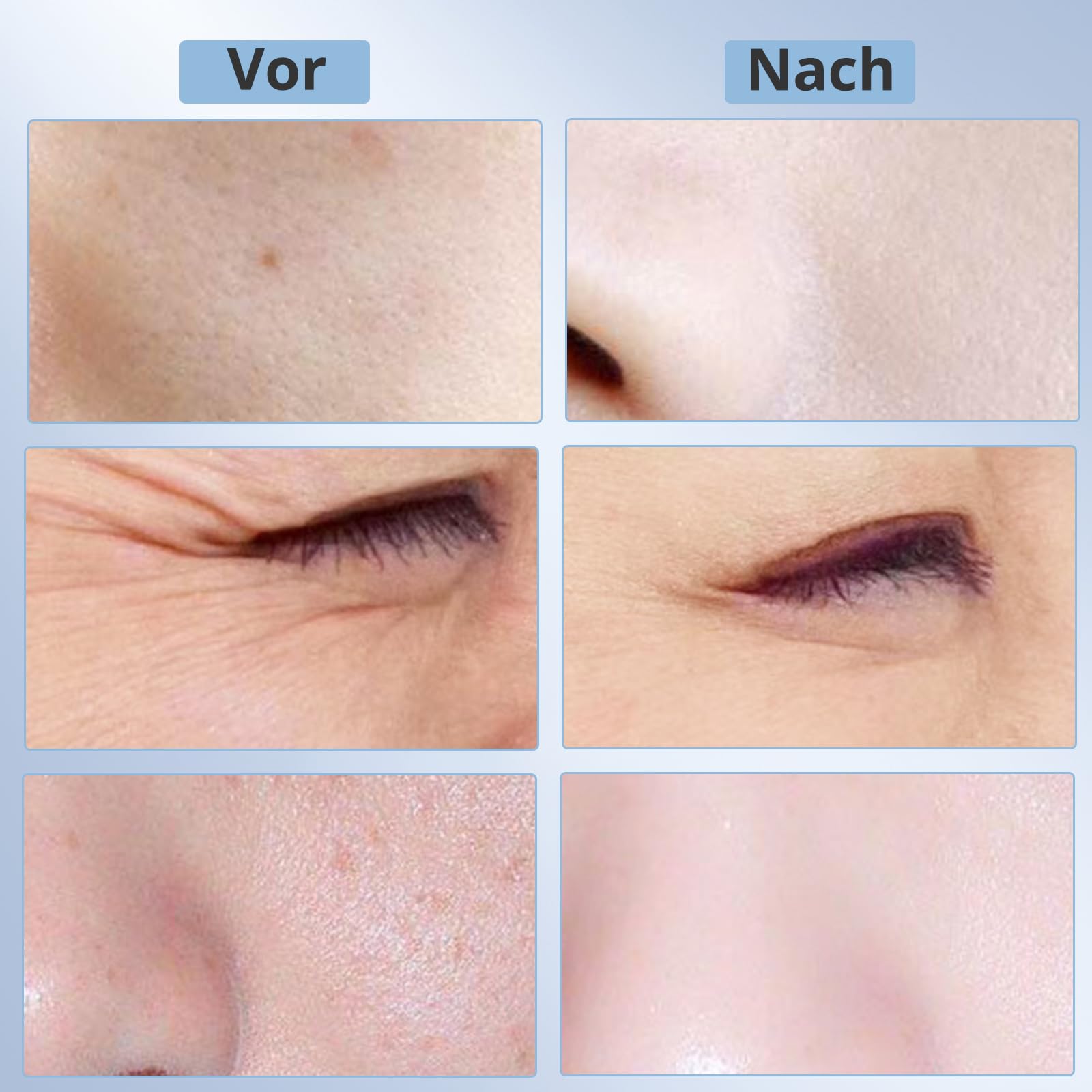 Elektrische Microneedling Pen mit 12 Nadelköpfe Tragbare,Micro Needle Roller Electric mit mit 7 Farben,9 Stufen,Wiederaufladbar Kabellos Mikronadel Stift