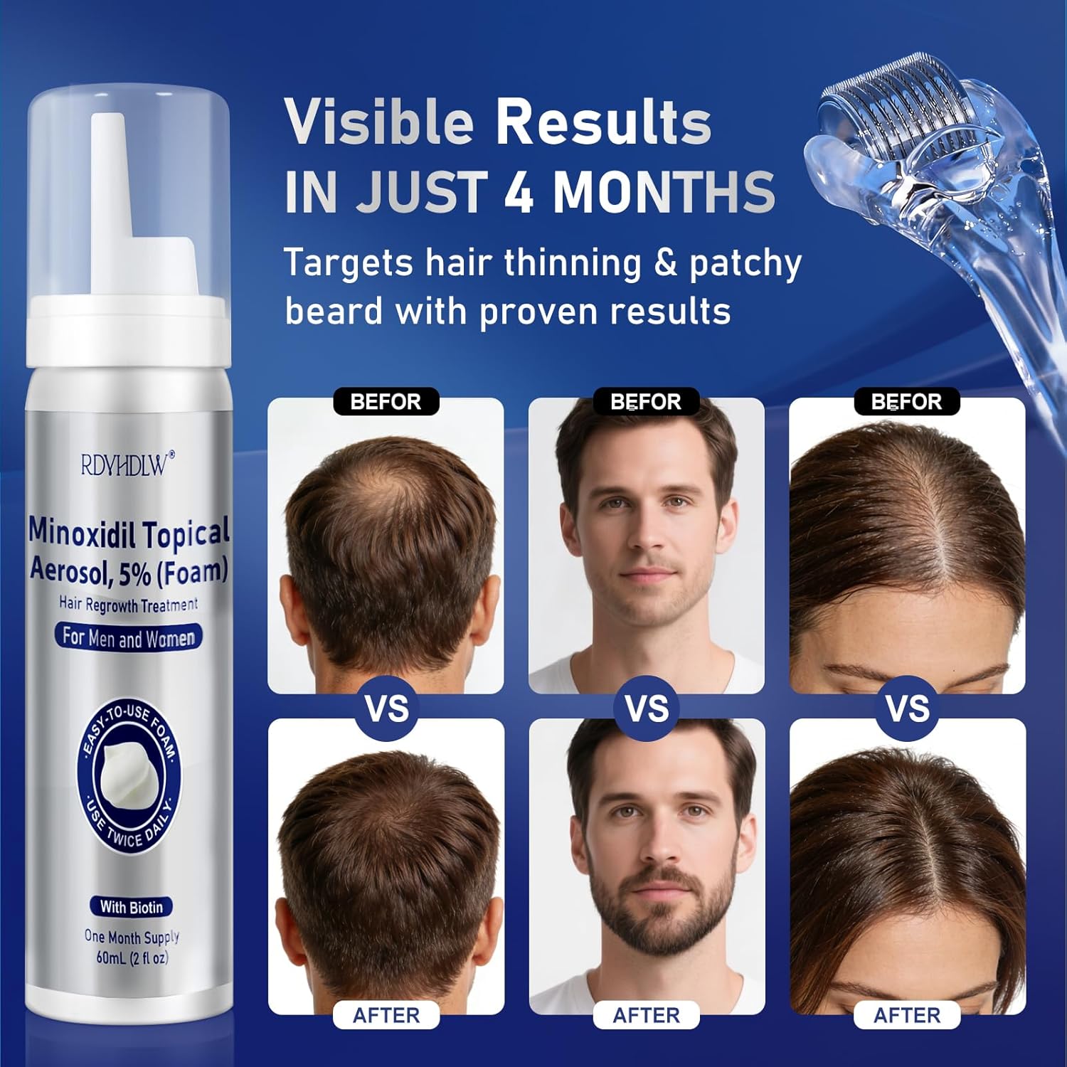 5% Minoxidil Foam for Men and Women Hair Growth, Minoxidil for Men Foam for Hair and Beard, Hair Regrowth Treatment Helps Regrow Hair Loss & Thinning (7pcs, 14.77oz, 7 Month Supply) - Image 3