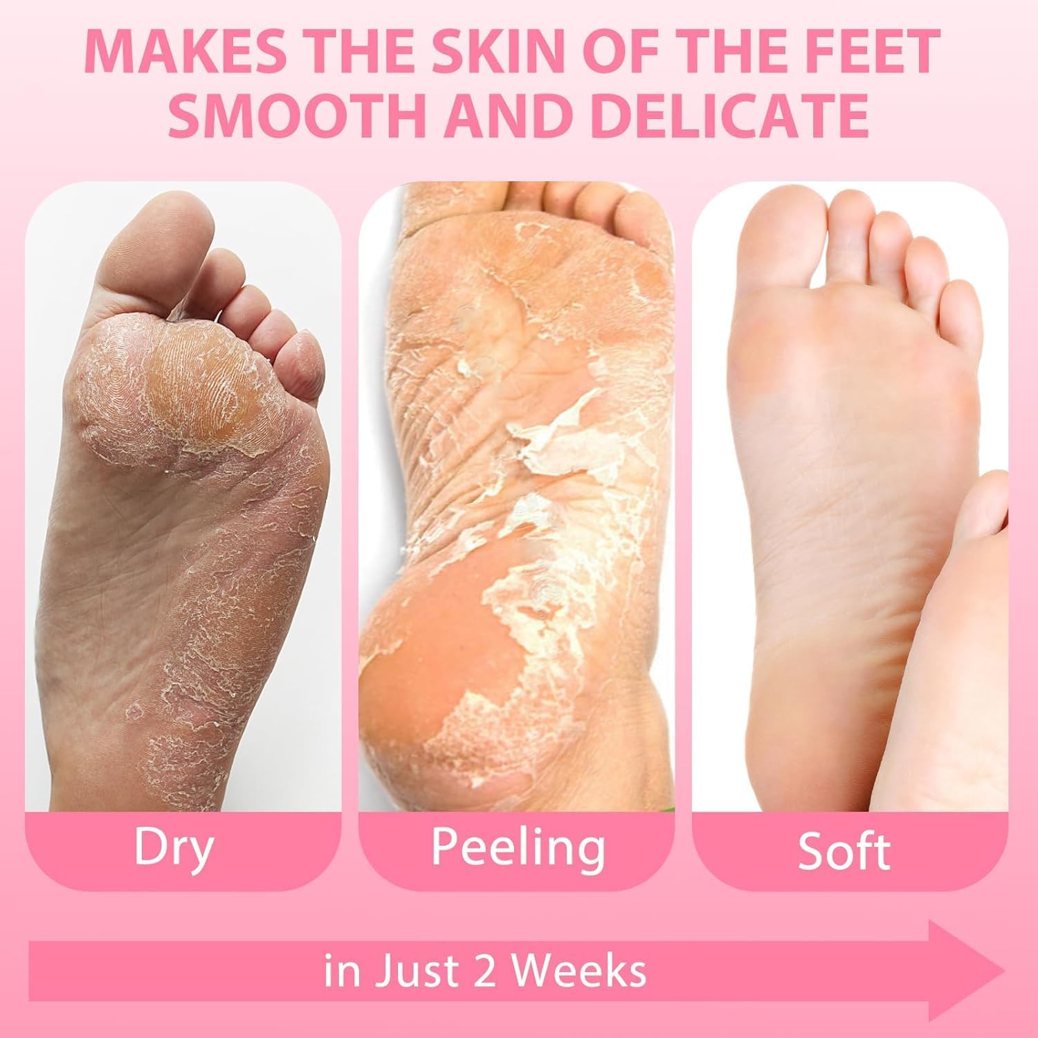iYOGIzz Foot Peel Mask for Dead Skin Removal, Exfoliating Callus Remover Spa Treatment, Deep Nourishing Skin Renewal for Dry Cracked Feet for Men & Women (Cherry) 3