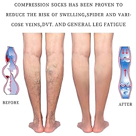 LIN PERFORMANCE 15-20 mmHg Medical Compression Stockings for Women and Men Thigh High Dot-Top Open Toe Socks for Varicose Vein Swollen legs Travel Flight Pregnant (Beige,3XL)