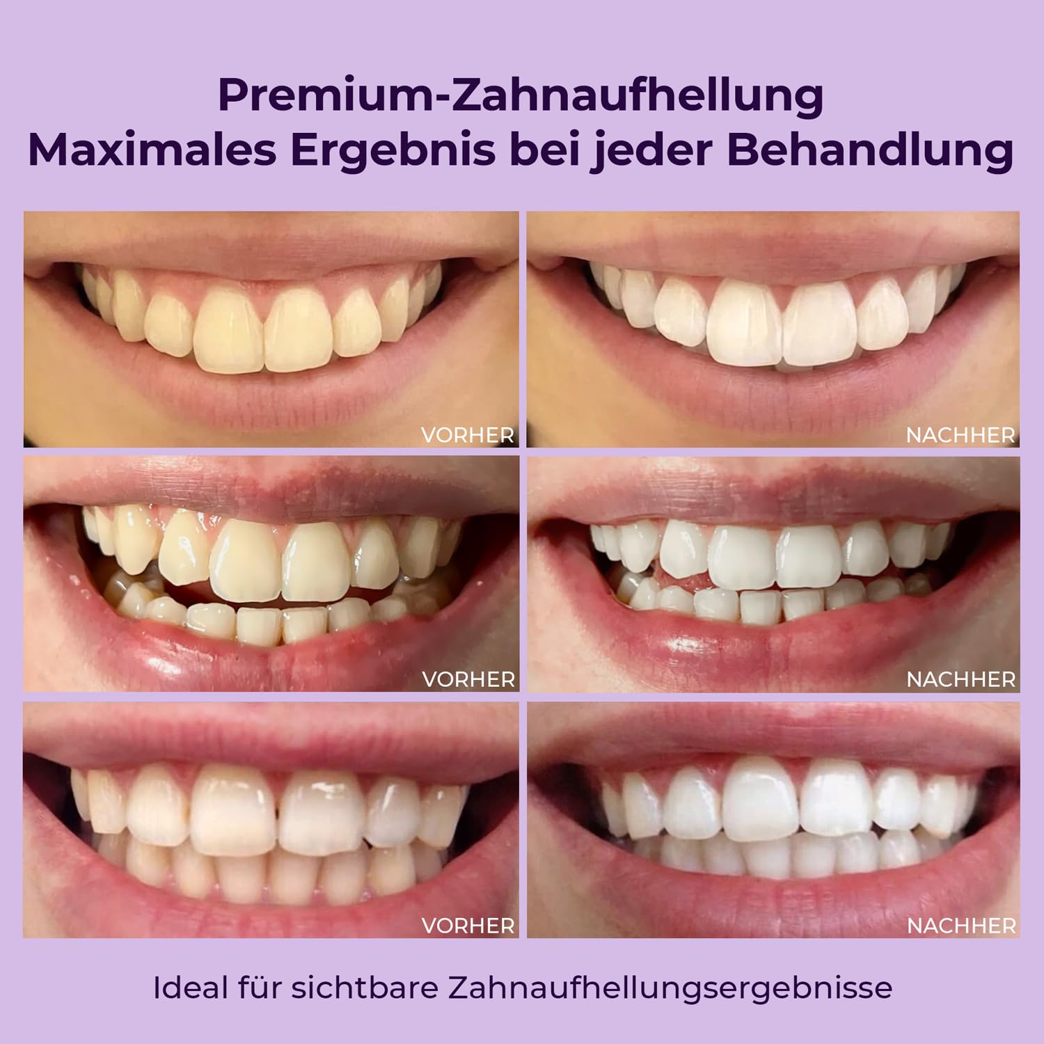 OnlySmile Zahnbleaching Set für empfindliche Zähne, Testsieger 2025 | Teeth Whitening Kit, Zahnaufheller für zu Hause entfernt Kaffee Tee Rotwein Tabak Verfärbungen, Zähne aufhellen in 5 Tagen