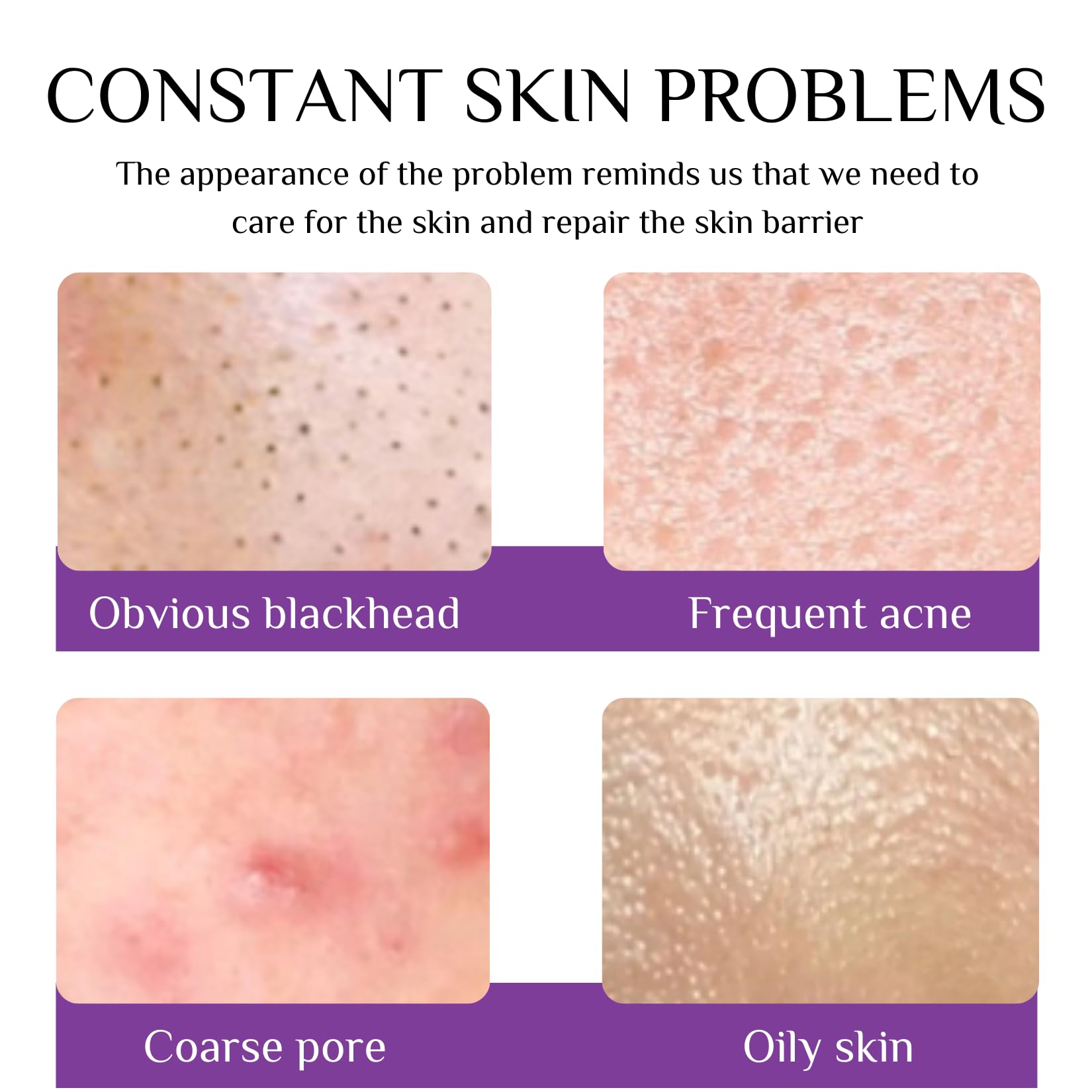 12% Acid Anti Acne Treatment Cream - Fade Acne Facial Serum Cream - Face Care Moisturizer Anti Spot for All Skin Types - Beauty Products for Rosacea,Fade Dark Spot,Pimple,Repair Skin (20ml) - Image 2