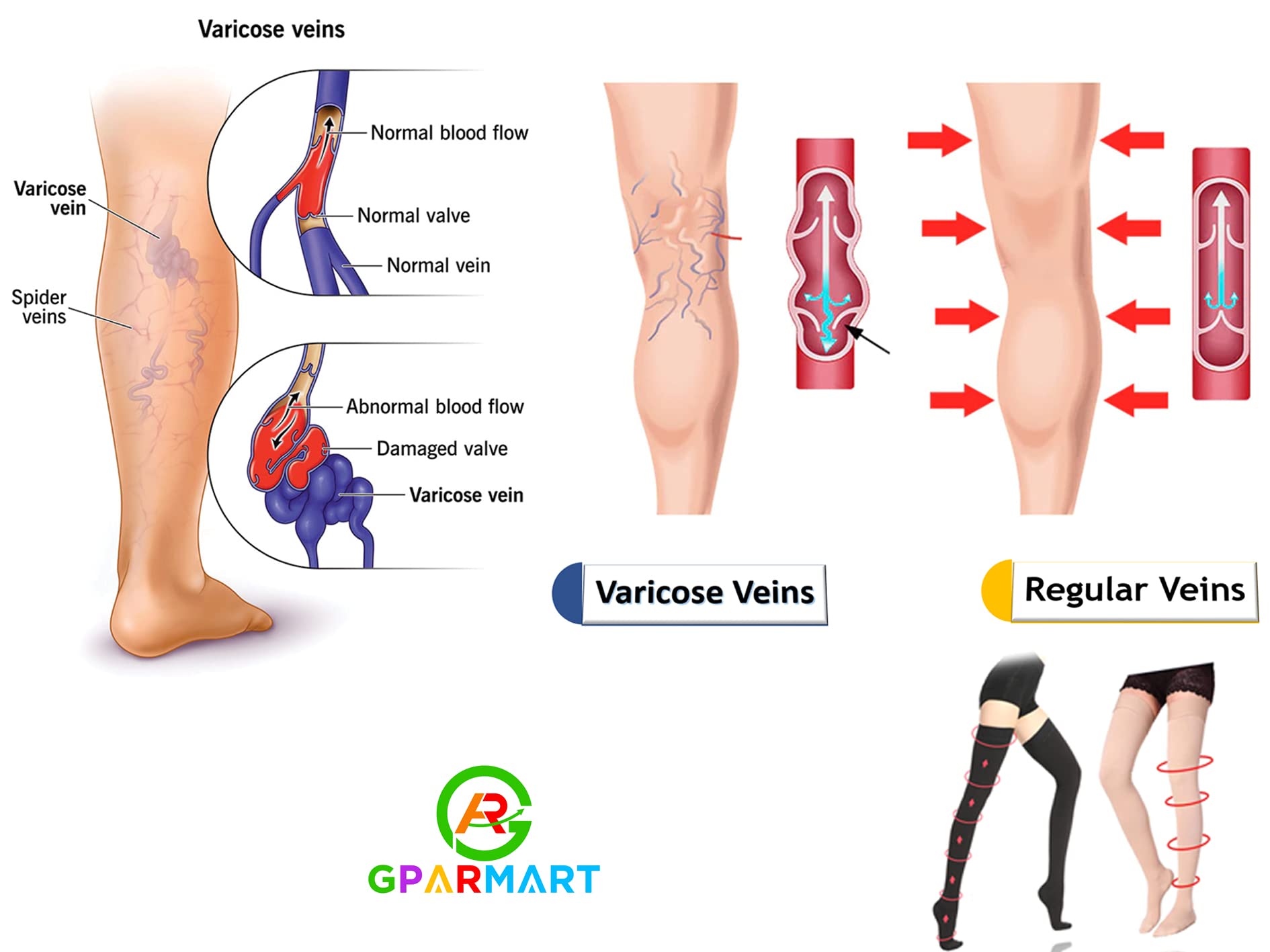 GPAR PREMIUM Calze a compressione medica - Punta chiusa - Coscia alta - Classe 2, 23-32 mmHG -per Vene Varicose, Edema, Dolore alle Gambe, Vene del ragno - Unisex (COLOR: BEIGE, SIZE: L)