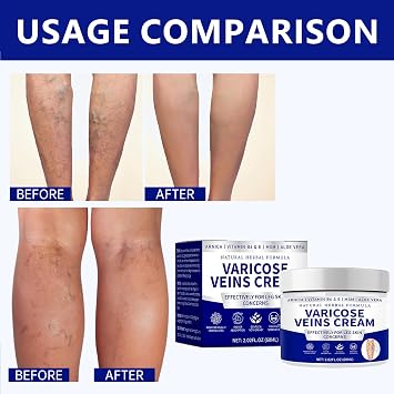 2026 Varicose Veins Legs Cream - Varicose Veins Cream, Spider Vein Cream with Natural Herbal Formula for Women and Men Leg Skin Care