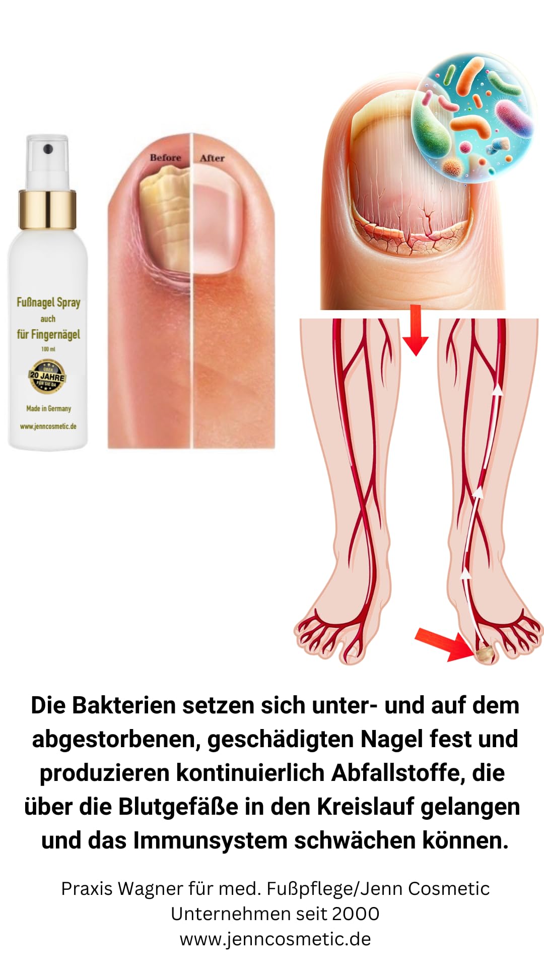 Spray pour les ongles des pieds, convient également pour les ongles