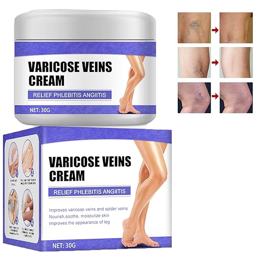 Cream for Varicose Veins, Spider Leg Repair Cream, Varicose Veins & Spider Vein Cream, Varicose Vein Repair Cream, Improves Apperance of Leg Circulation and Blood