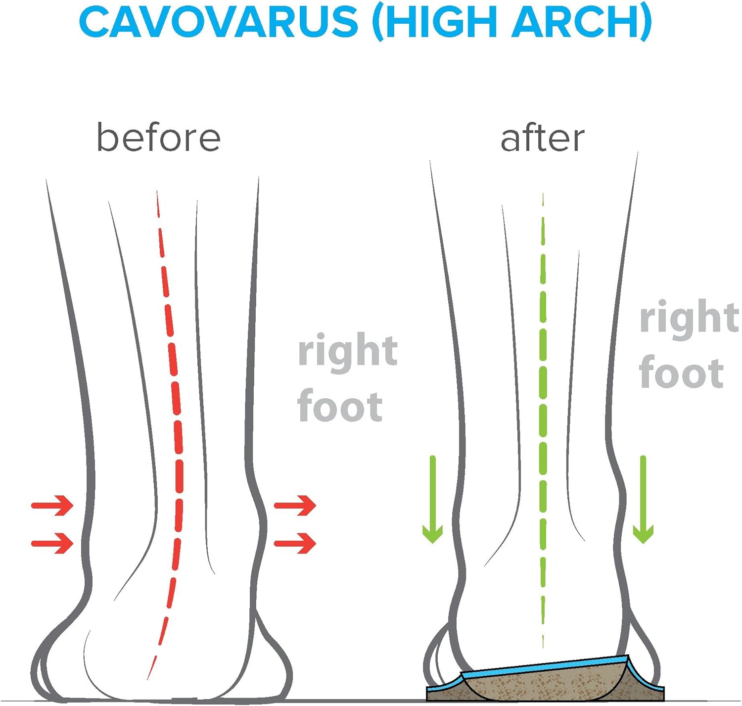 Arches Insoles Type 3 - Supination/High Arch, Men's Size 16-16.5/ Women's Size 18-18.5 - Image 4