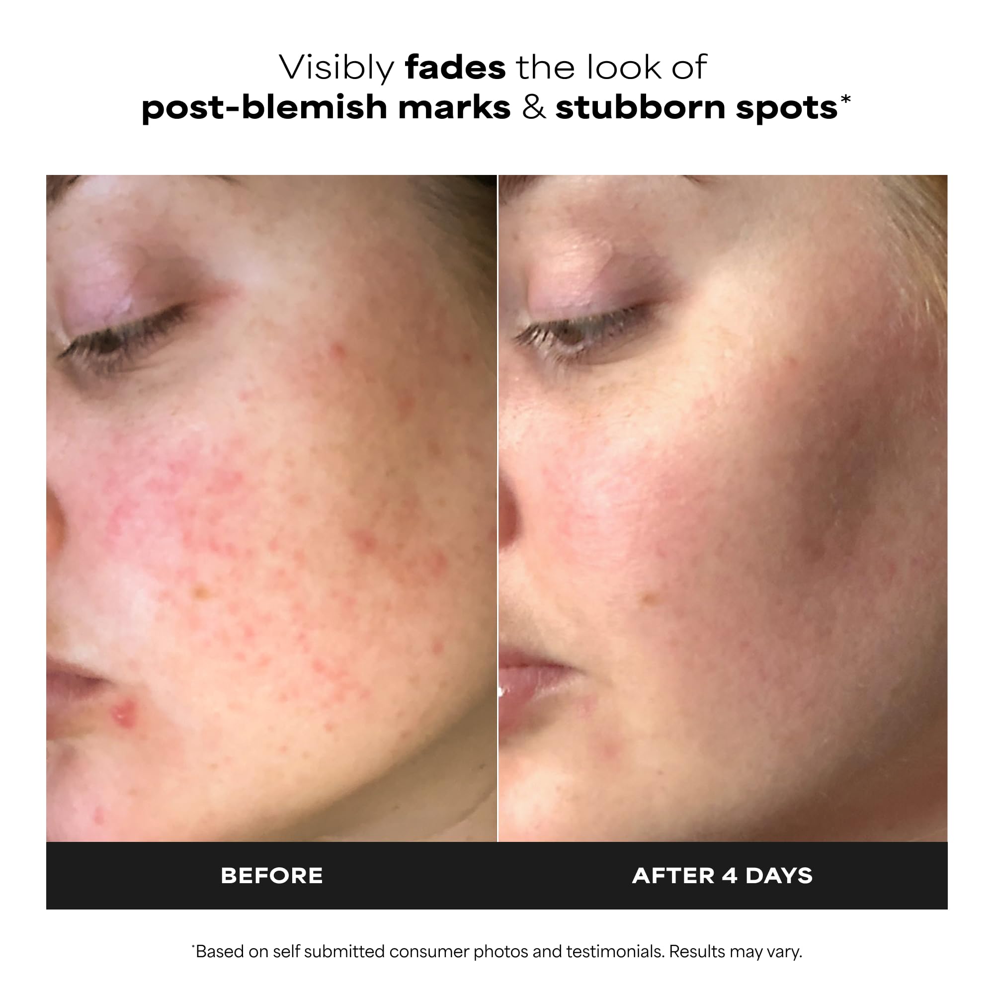 Paula's Choice 10% Kwasem Azelainowy BOOSTER - Serum do Twarzy Rozjaśnia Brązowych Przebarwień & Zwalcza Wypryski - z Salicylowym - Wszystkie Rodzaje Skóry - 30 ml