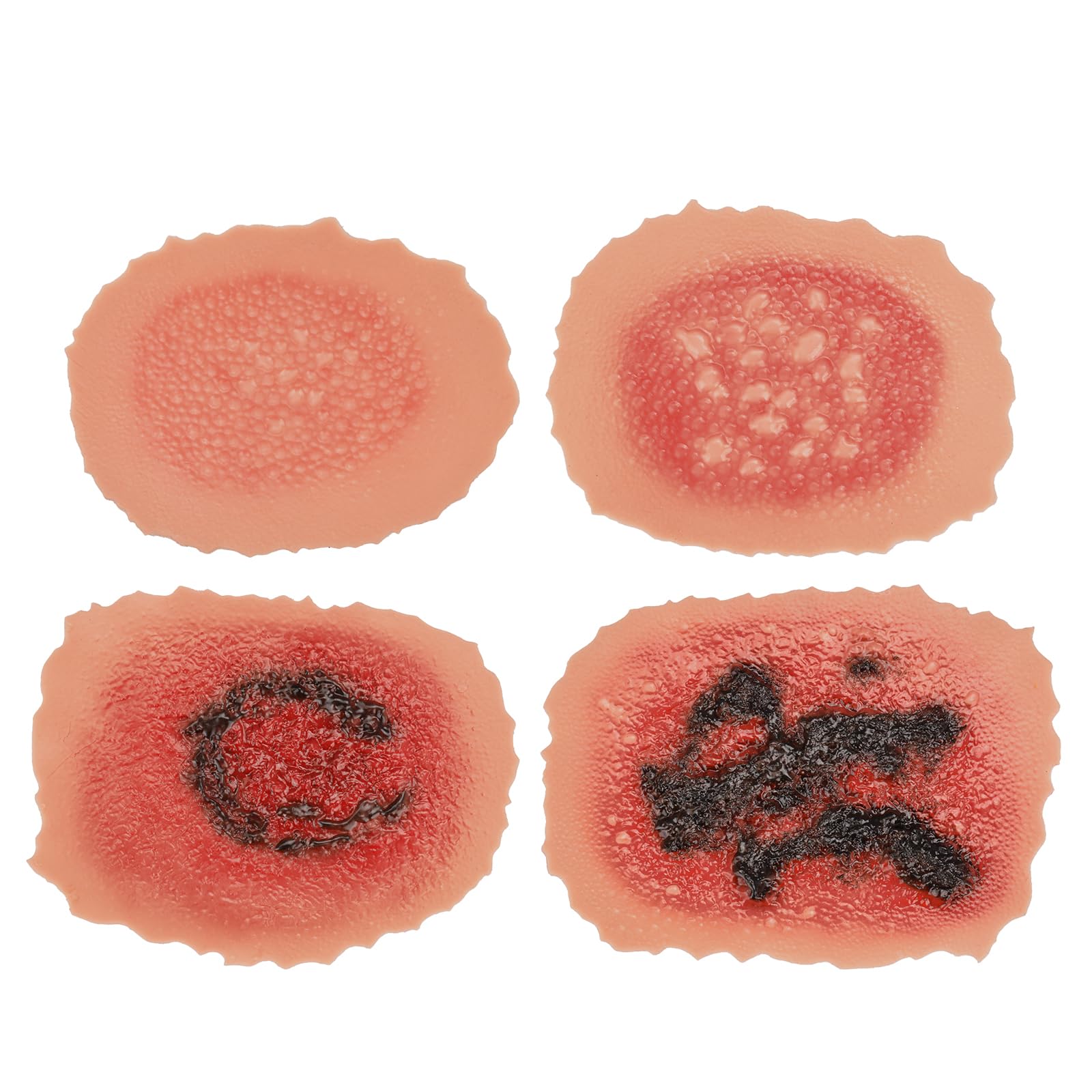Burn Wound Model Set, Adhesive First to Fourth Degree