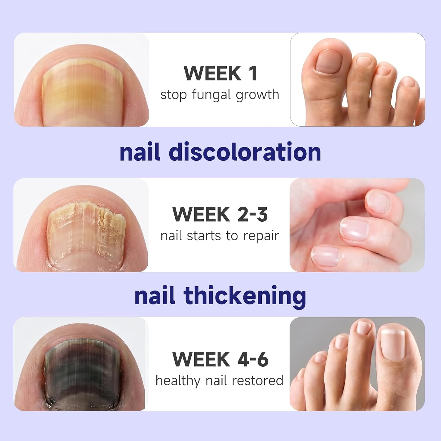 Toenail Fungus Treatment at Home, Restorative Nail Repair for Damaged Nails,Improve Yellowing, Thickening, and Cracking of the nails & Toenails，1 Fl Oz
